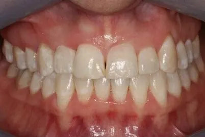Case 1, after treatment: the same patient's smile, close up.