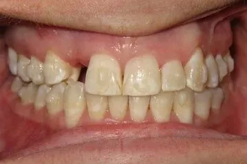 Case 1, before treatment: the patient's smile, close up.