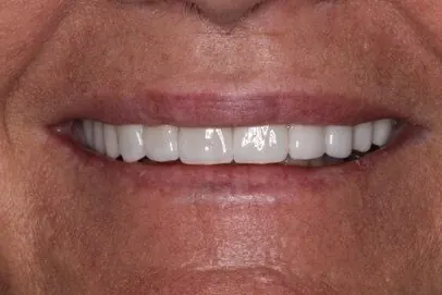 Case 2, after treatment: the same patient's smile, close up.