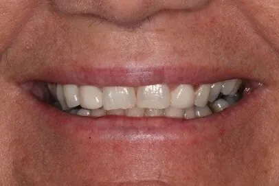 Case 2, before treatment: the patient's smile, close up.