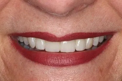 Case 3, after treatment: the same patient's smile, close up.