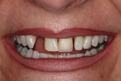 Case 3, before treatment: the patient's smile, close up.