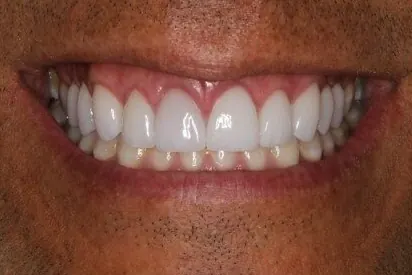 Case 4, after treatment: the same patient's smile, close up.