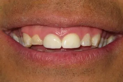 Case 4, before treatment: the patient's smile, close up.