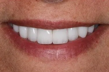 Case 5, after treatment: the same patient's smile, close up.