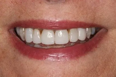 Case 5, before treatment: the patient's smile, close up.