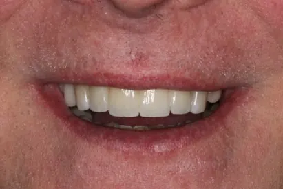 Case 6, after treatment: the same patient's smile, close up.