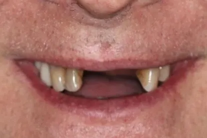 Case 6, before treatment: the patient's smile, close up.